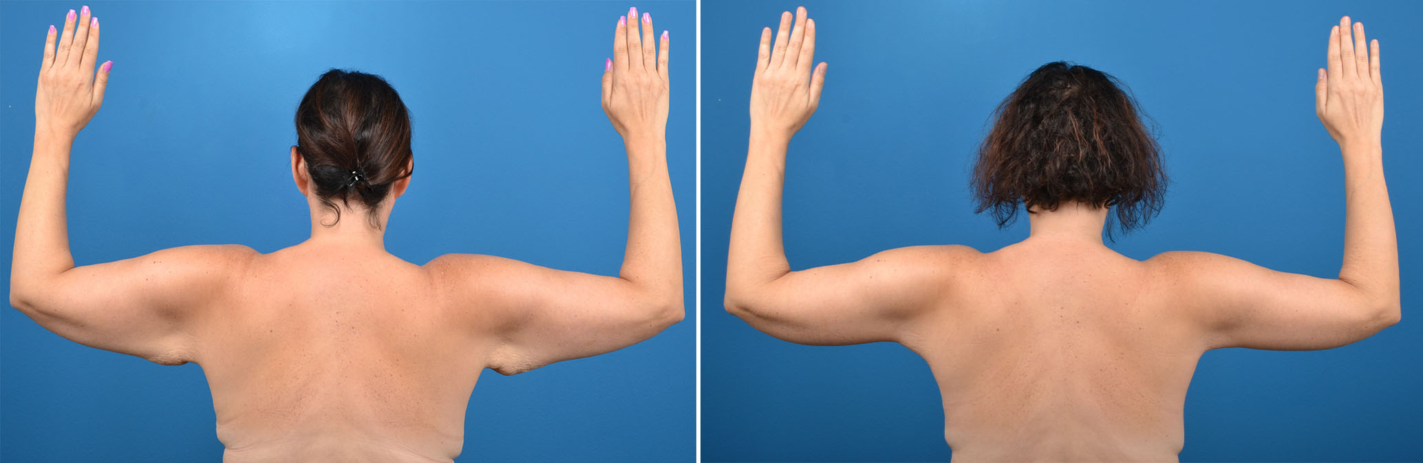 Brachioplasty (Arm Lift) Surgery in Florida